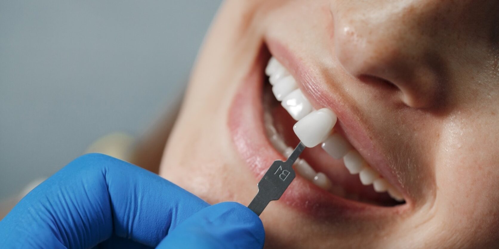 Tratamiento De Implantes Con Carga Inmediata En Valencia Ces Dental