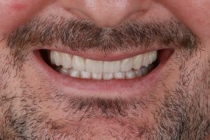 estética dental en Burjassot - sonrisa frontal