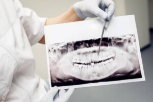 dentistas en burjassot - placa